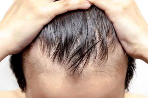 Bariatrik Cerrahi Sonrası Saç Dökülmesi